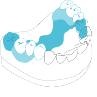 Kombinierte Prothese Kombinierte Prothese