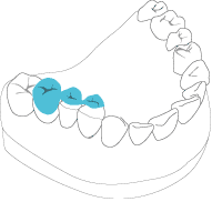 Zahnersatz aus Zirkoniumdioxid