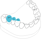 Zahnersatz aus Zirkoniumdioxid